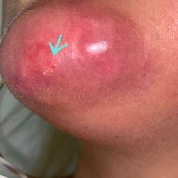 Bade Medikal & Cerrahi Estetik Danışmanlığı Çene Dolgusu Kabusu, Enfeksiyon Ve Doku Kaybı