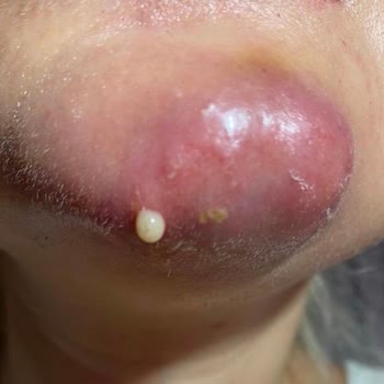 Bade Medikal & Cerrahi Estetik Danışmanlığı Çene Dolgusu Kabusu, Enfeksiyon Ve Doku Kaybı