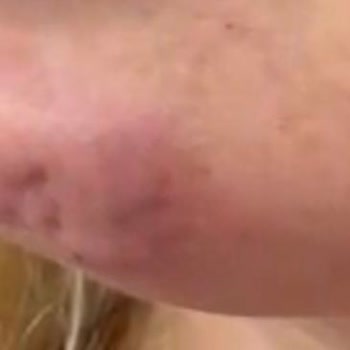 Bade Medikal & Cerrahi Estetik Danışmanlığı Çene Dolgusu Kabusu, Enfeksiyon Ve Doku Kaybı