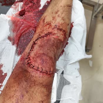 Alo 184 Sağlık Bakanlığı İletişim Merkezi Kanaması Durmayan Hastaya Ambulans