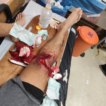 Alo 184 Sağlık Bakanlığı İletişim Merkezi Kanaması Durmayan Hastaya Ambulans