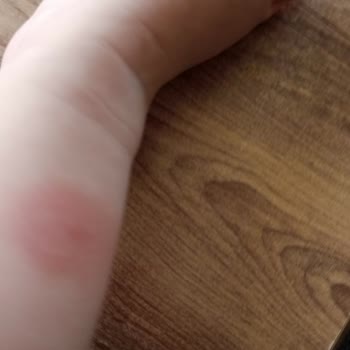 Kocaeli Büyükşehir Belediyesi Sivri Sinek İçin İlaçlama Talebi