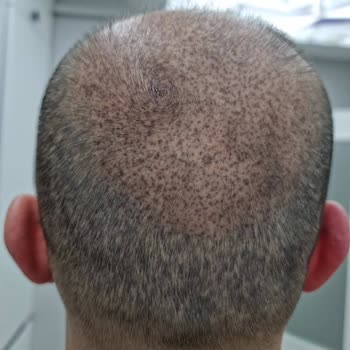 Hfs Center Yanıltıcı Hizmet Ve Kalıcı Cilt Hasarı