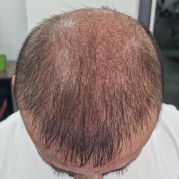 Hfs Center Yanıltıcı Hizmet Ve Kalıcı Cilt Hasarı