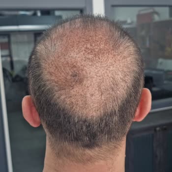 Hfs Center Yanıltıcı Hizmet Ve Kalıcı Cilt Hasarı