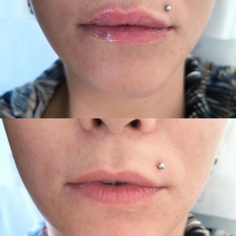 Juve Clinic Güzellik Merkezi Dudak Dolgusu Memnuniyetsizliği