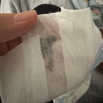 Molfix Bebek Bezi İçerisinde Yabancı Maddeler Çıktı