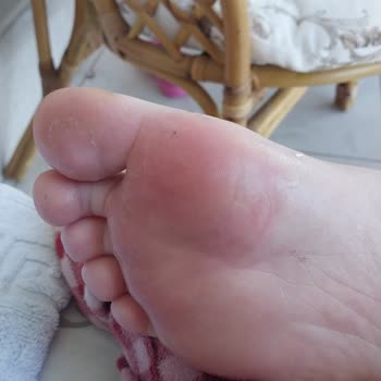 Lacoste Sandals Shrunk and Caused Pain