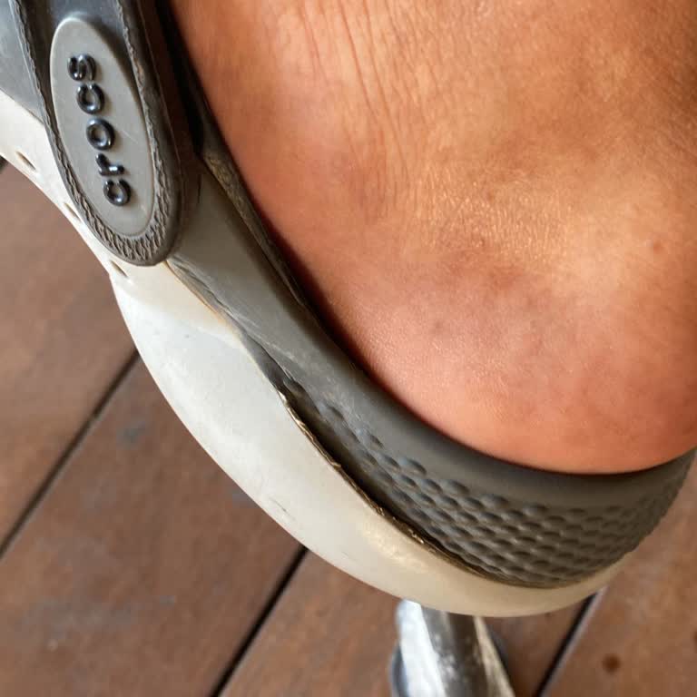 Crocs Terlik & Ayakkabı Bu Kadar Erken Hasar Alması İnanılır Gibi Değil!