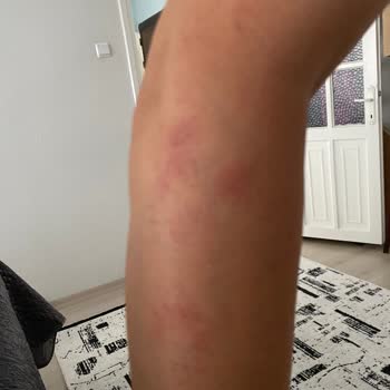 Golden Güzellik Lazer Epilasyon Sonrası Yanık Ve Saygısız Hizmet