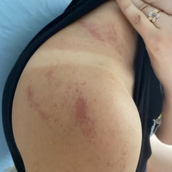 Golden Güzellik Lazer Epilasyon Sonrası Yanık Ve Saygısız Hizmet