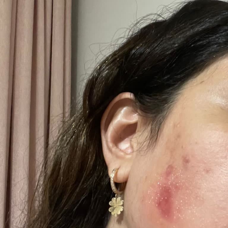 Gratis Ürünü Gül Suyu Yüzümü Yaktı