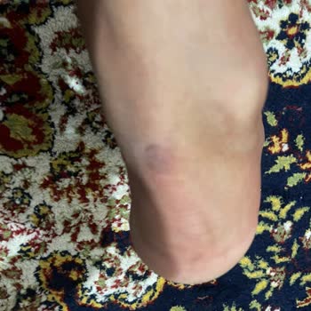 Decathlon Yeni Aldığım Ayakkabı Ayağımı Yara Yaptı Ve İade Kabul Edilmedi