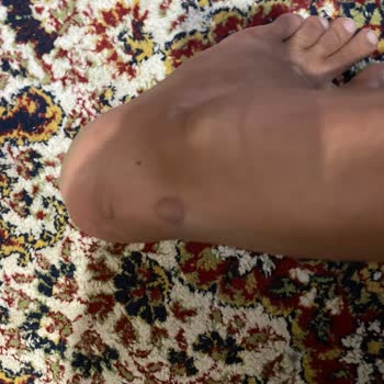 Decathlon Yeni Aldığım Ayakkabı Ayağımı Yara Yaptı Ve İade Kabul Edilmedi