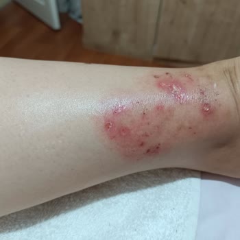 Artçüre Tedavisinde 2. Derece Yanık Ve Hayal Kırıklığı