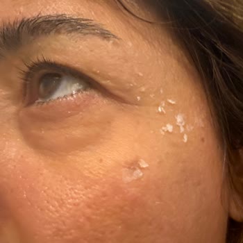 Watsons Makyaj Temizleyici İle Cilt Yanığı