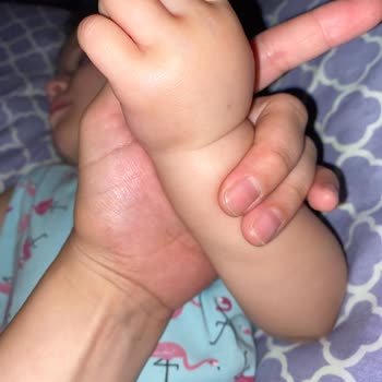 Türkiye Hastanesi 1 Yaş Serum Bilek El Şişmesi