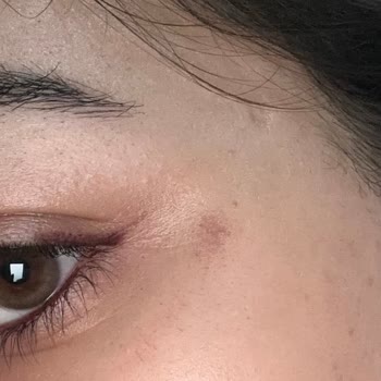 Eda Demir Beauty Center (Çorum) Lazerde Yüz Yanması!