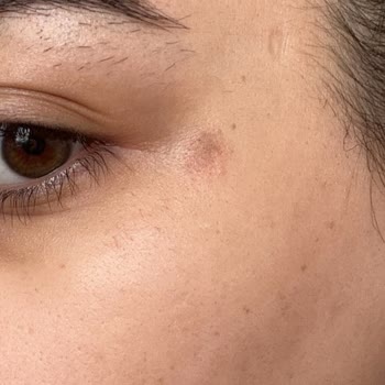 Eda Demir Beauty Center (Çorum) Lazerde Yüz Yanması!