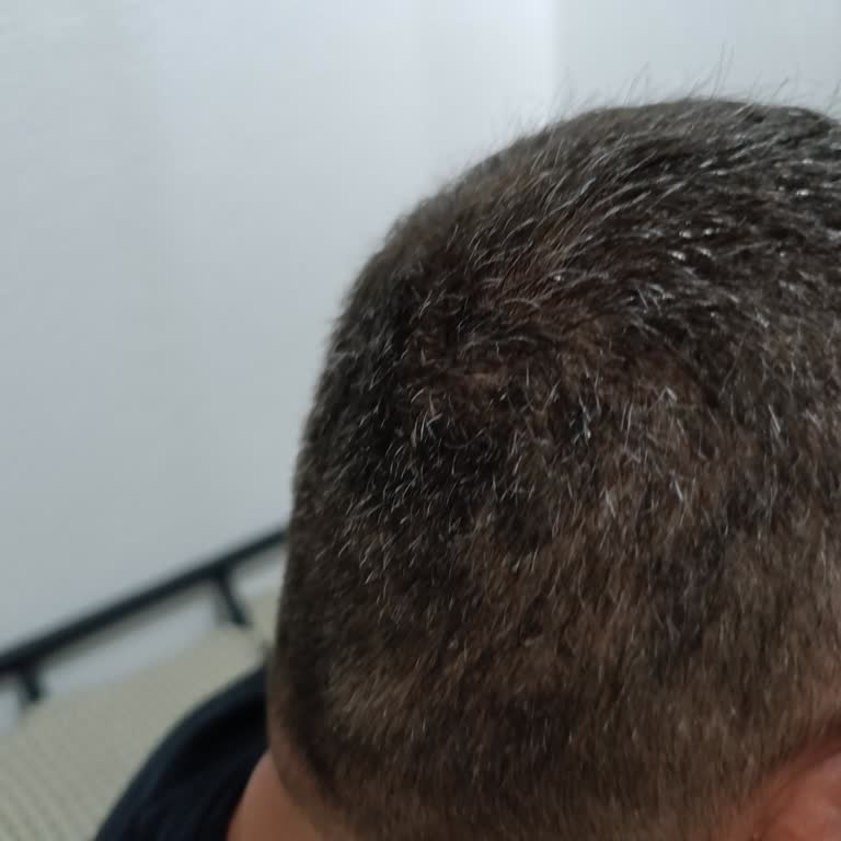 Bioxcin 10 Yıllık Kullanımda Saç Beyazlamasını Artırdı