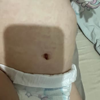 Molfix Mavi Bez Alerji Yapıyor