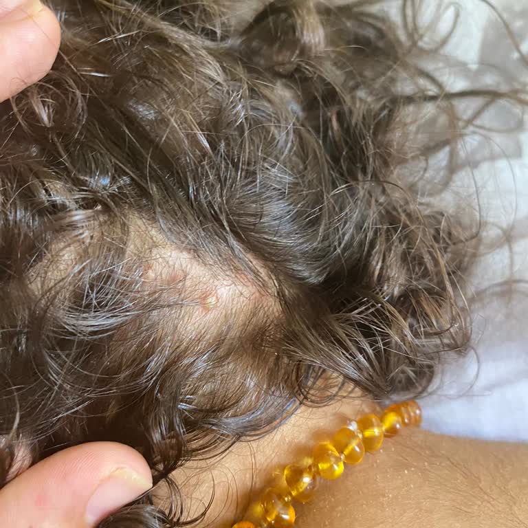 Paranit Bitten Kurtulmak İsterken Hastanelik Oldu!