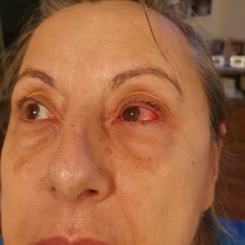 Asperox Sparx Patlama Ve Göze Zarar Verme