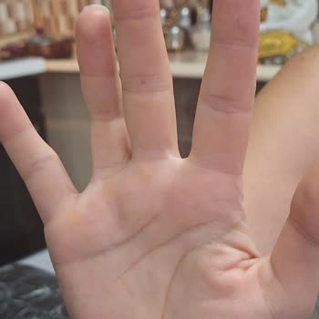 Kayseri Acıbadem Hastanesi İşe Yaramayan İki Ameliyat