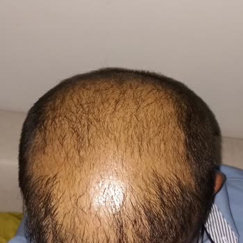 Anatolia Saç Ekim Merkezinde Hayal Kırıklığı