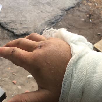 Kapaklı Devlet Hastanesi Alçıyı Düzgün Yapamadılar