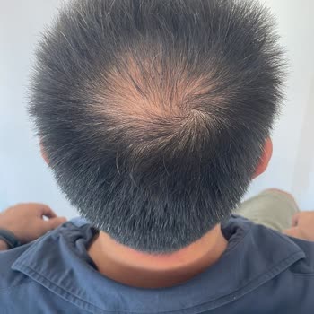 Estetistanbul Tıp Merkezi Estet İstanbul Sac Ekiminde Acı Çektiriyor