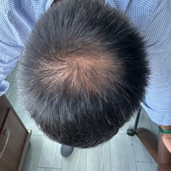 Estetistanbul Tıp Merkezi Estet İstanbul Sac Ekiminde Acı Çektiriyor