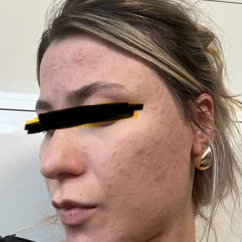 Yves Rocher Stem Cell Serum - Skin Reaction and Refund Issue