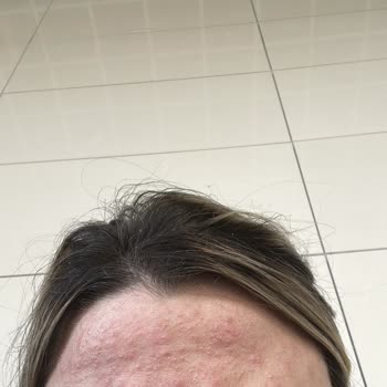 Yves Rocher Stem Cell Serum - Skin Reaction and Refund Issue