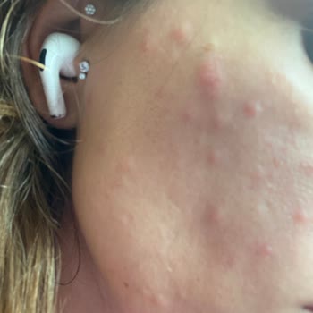 Yves Rocher Moisturizer Caused Breakouts on My Face