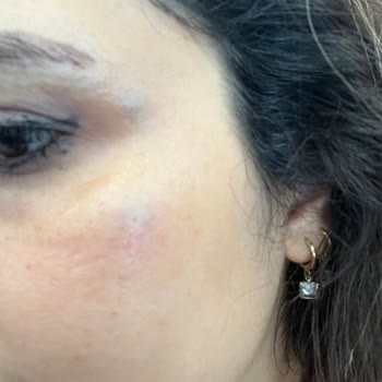 AZT Clinic (Ataşehir) Azt Klinik Botoks Mağduriyeti. Yüzüm Morardı