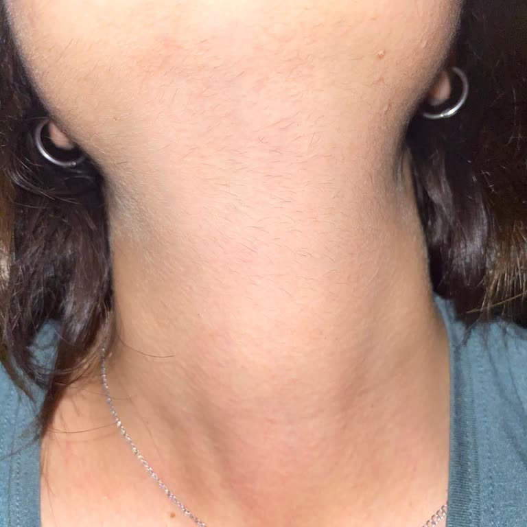 Özel Levent Dnz Polikliniği Yanlış Lazer Uygulaması Ve İlgisizlik Mağduriyeti