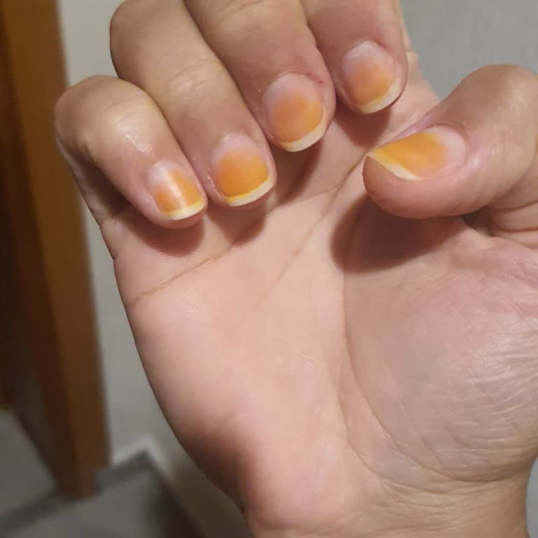 Flormar Oje Sonrası Tırnakların Turunculaşması