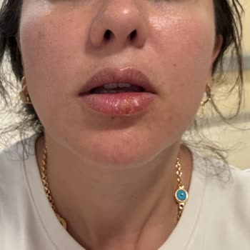 NFC Estetik Dudak Dolgusu Eritme Sonrası Enfeksiyon