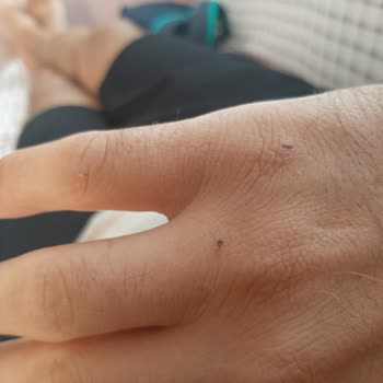 Ajet Kırık Koltuktan Düşürdü.