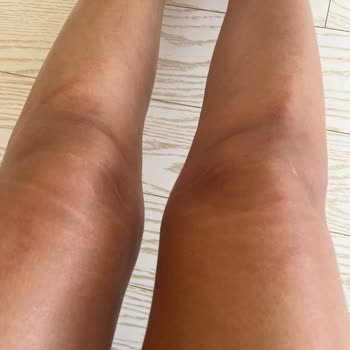 Esta World Bacaklarıma Lazer İşlemi Yaptırdım Yandı