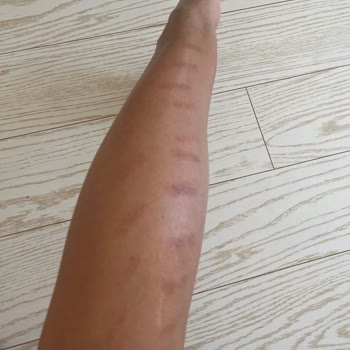 Esta World Bacaklarıma Lazer İşlemi Yaptırdım Yandı