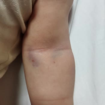 Gaziantep Bossan Hastanesi Hemşirelerinin Deneyimsizliği