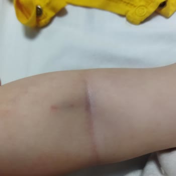 Gaziantep Bossan Hastanesi Hemşirelerinin Deneyimsizliği