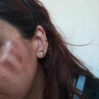 Queenzz Estetik ve Güzellik Merkezi Lazer Sonucu Yanık