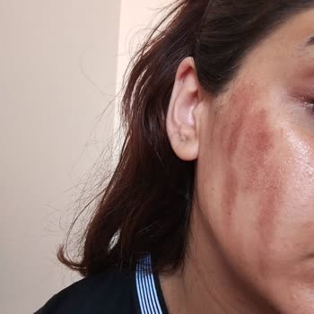 Queenzz Estetik ve Güzellik Merkezi Lazer Sonucu Yanık