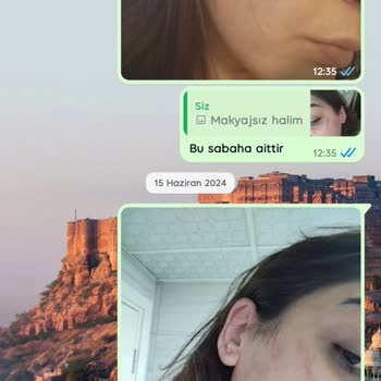 Queenzz Estetik ve Güzellik Merkezi Lazer Sonucu Yanık