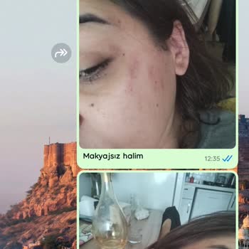 Queenzz Estetik ve Güzellik Merkezi Lazer Sonucu Yanık