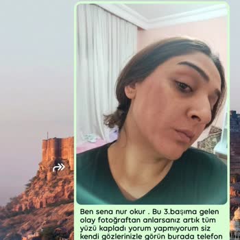 Queenzz Estetik ve Güzellik Merkezi Lazer Sonucu Yanık