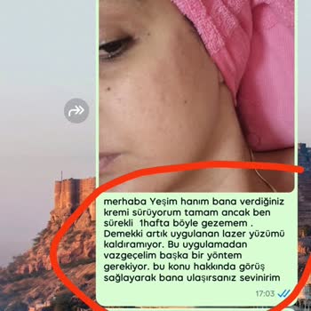 Queenzz Estetik ve Güzellik Merkezi Lazer Sonucu Yanık